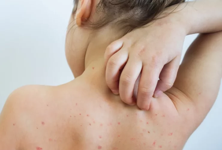 The Chicago CDC itself verified four cases of measles