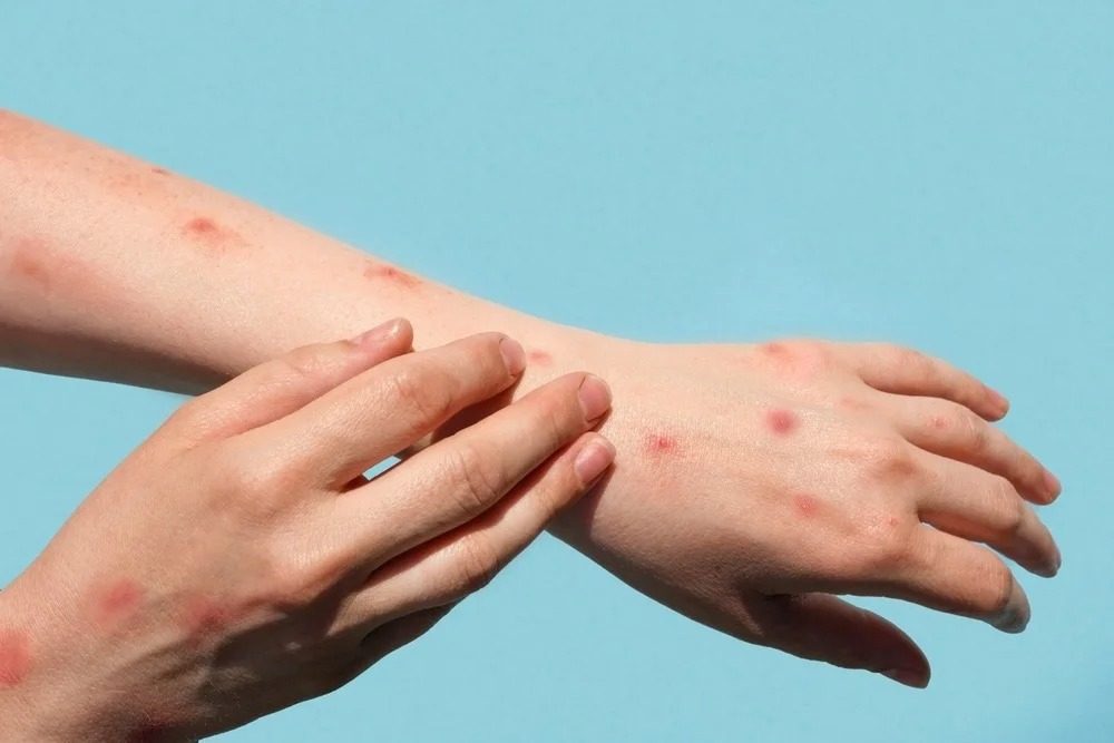 Mpox Cases Doubles in US, Vaccination Crucial for High-Risk Groups: CDC. Credit | Shutterstock