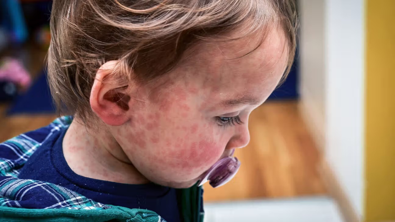 CDC Issues Health Advisory as Measles Cases Surge in US. Credit | Getty Images