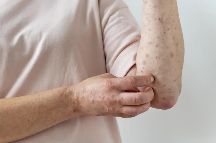 CDC Issues Health Advisory as Measles Cases Surge in US. Credit | FREEPIK